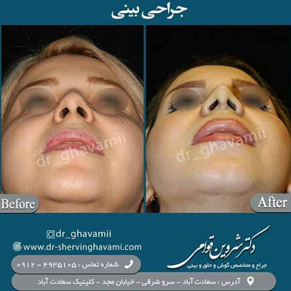 عمل جراحی زیبایی بینی