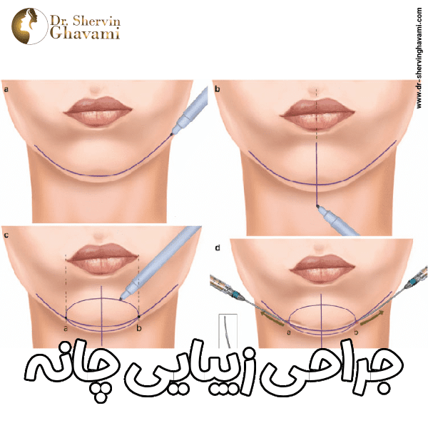 مراحل جراحی چانه - دکتر شروین قوامی