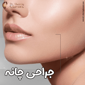جراحی زیبایی چانه - دکتر شروین قوامی