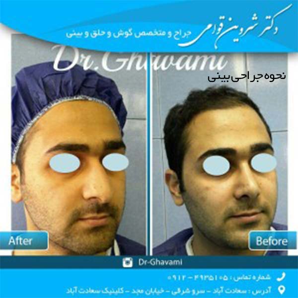 نحوه جراحی بینی