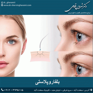 بلفاروپلاستی