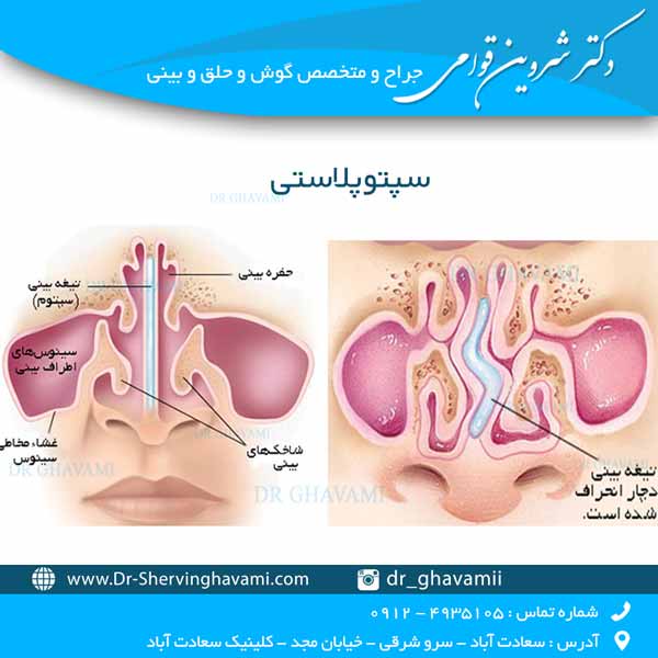 سپتوپلاستی