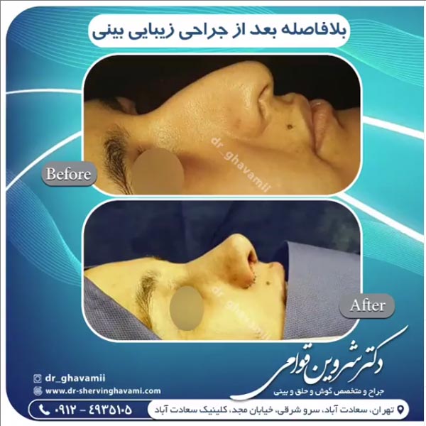 جراحی ترمیمی بینی - دکتر قوامی