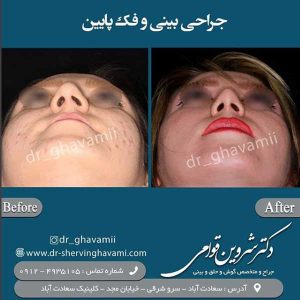 جراحی زیبایی بینی- دکتر قوامی