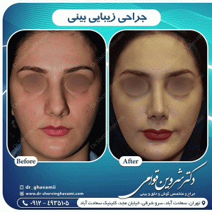 بهترین جراح بینی تهران - دکتر قوامی