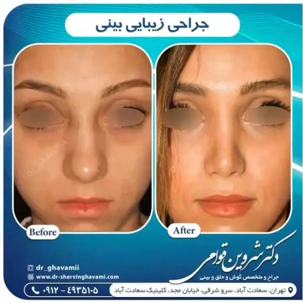 جراحی بینی