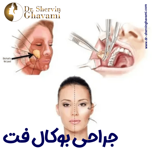 جراحی بوکال فت - دکتر شروین قوامی