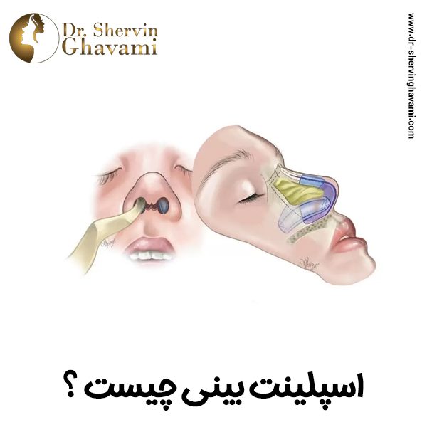 اسپلینت بینی _ دکتر شروین قوامی