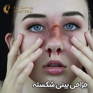 جراحی بینی شکسته -دکتر شروین قوامی