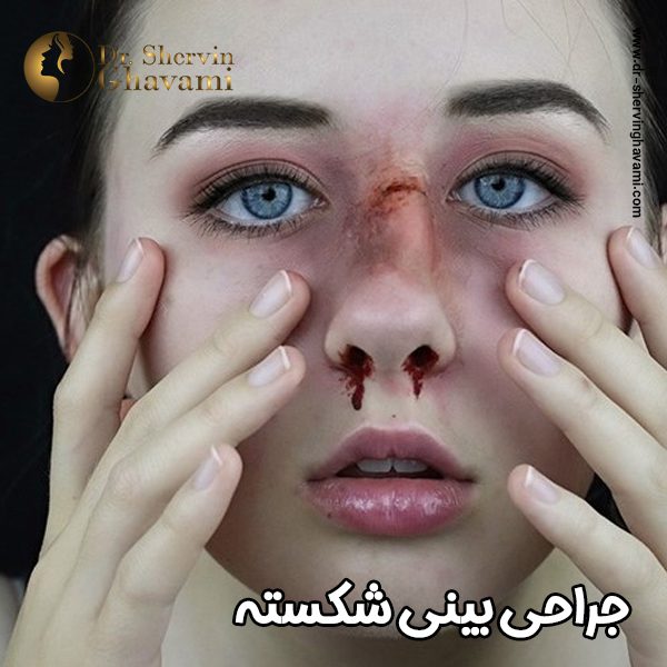 جراحی بینی شکسته -دکتر شروین قوامی