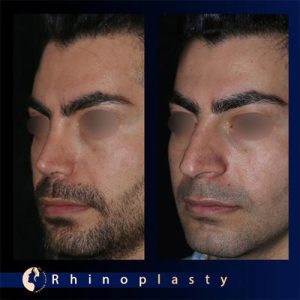 جراحی بینی فانتزی مردانه - دکتر شروین قوامی
