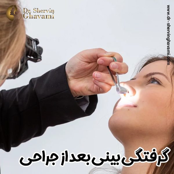 گرفتگی بینی بعد از جراحی بینی - دکتر شروین قوامی