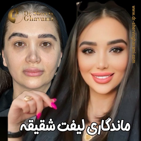 ماندگاری لیفت شقیقه - دکتر شروین قوامی