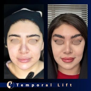 نمونه کار بهترین دکتر لیفت شقیقه در تهران - دکتر شروین قوامی