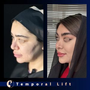 نمونه کار بهترین دکتر لیفت شقیقه در تهران - دکتر شروین قوامی