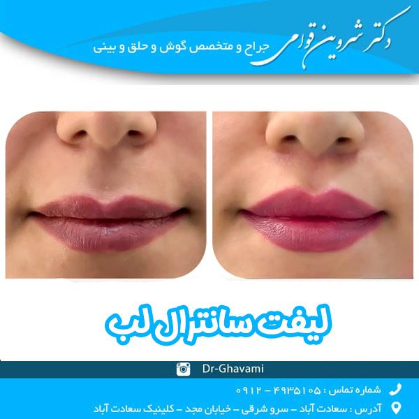 لیفت سانترال لب - دکتر شروین قوامی - dr-shervinghavami.com