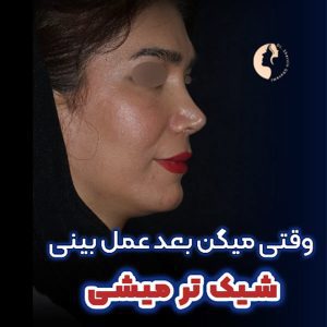 عکس جراحی بینی بسته - دکتر قوامی - dr-shervinghavami.com