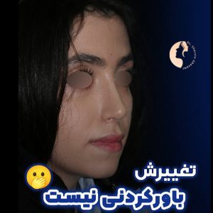 عکس عمل بینی بسته - دکتر قوامی - dr-shervinghavami.com