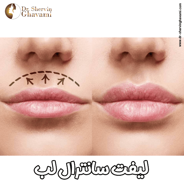 لیفت سانترال لب - دکتر شروین قوامی