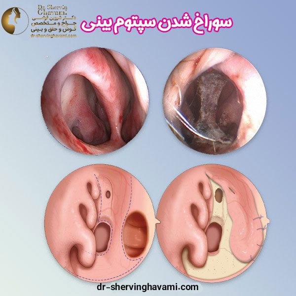 سوراخ سپتوم بینی - دکتر شروین قوامی - dr-shervinghavami.com