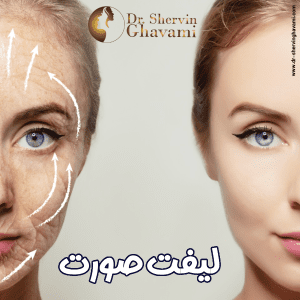 لیفت صورت - دکتر شروین قوامی