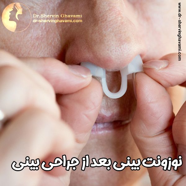 نوزونت بینی بعد از جراحی بینی با دکتر شروین قوامی