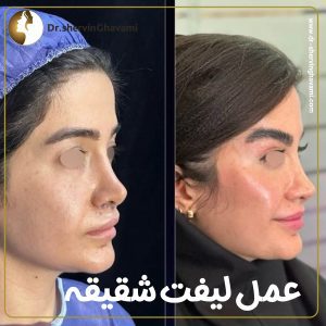 عکس قبل و بعد لیفت شقیقه در تهران