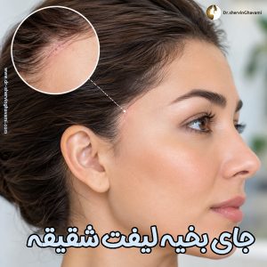 جای بخیه لیفت شقیقه - دکتر شروین قوامی