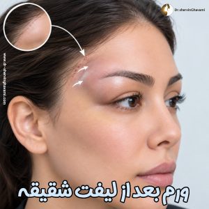 ورم بعد از لیفت شقیقه