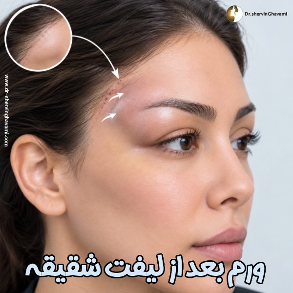 ورم بعد از لیفت شقیقه