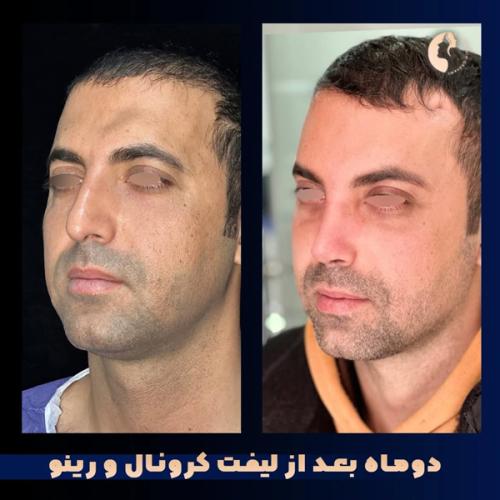 جراحی-بینی-571
