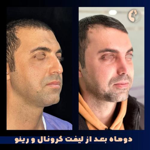 جراحی-بینی-572