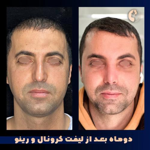 جراحی-بینی-573