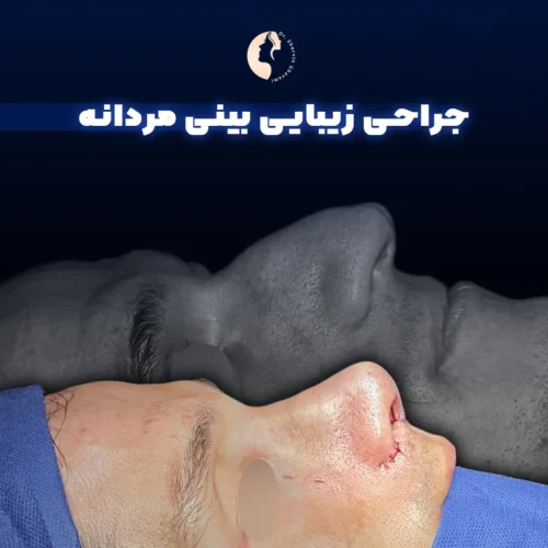 جراحی-بینی-574