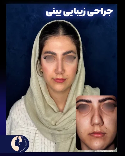 جراحی-بینی-579
