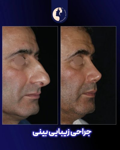 جراحی-بینی-581