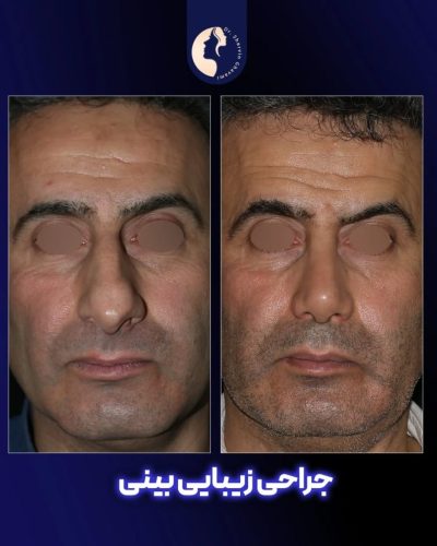 جراحی-بینی-582
