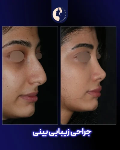 جراحی-بینی-584