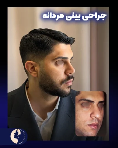 جراحی-بینی-585