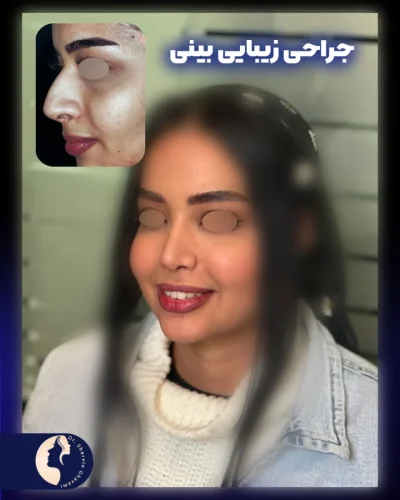 جراحی-بینی-586