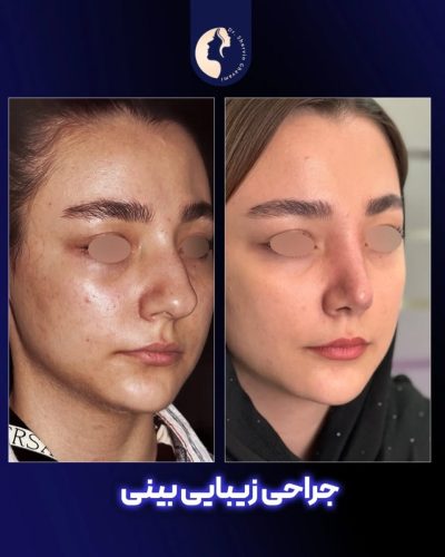 جراحی-بینی-588
