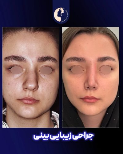 جراحی-بینی-589
