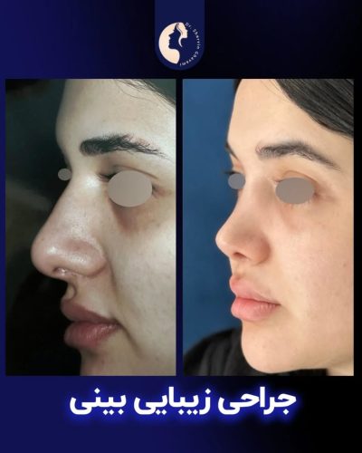 جراحی-بینی-590
