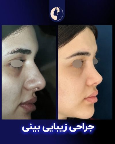 جراحی-بینی-591