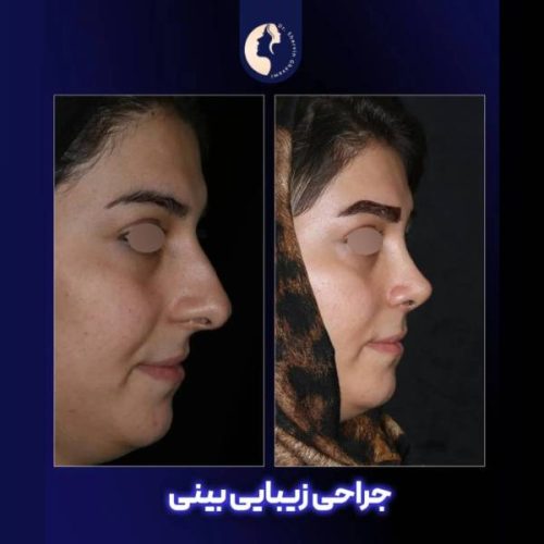 جراحی-بینی-595