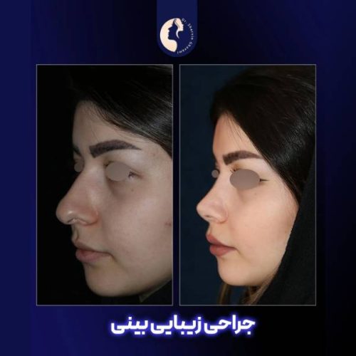 جراحی-بینی-598