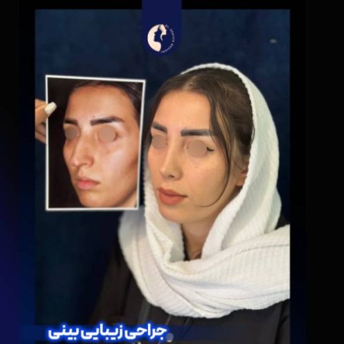 جراحی-بینی-602
