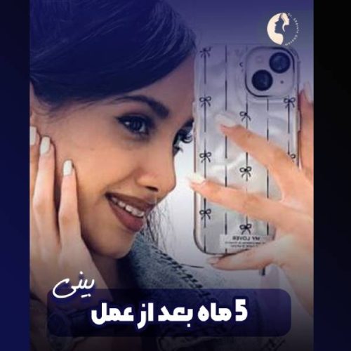 جراحی-بینی-603