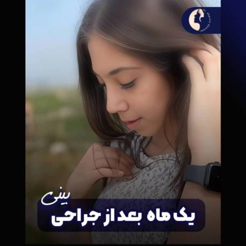 جراحی-بینی-606