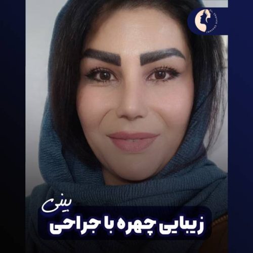 جراحی-بینی-609